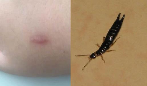 蠼螋咬人后的症状图片蠼螋防止方法解读图