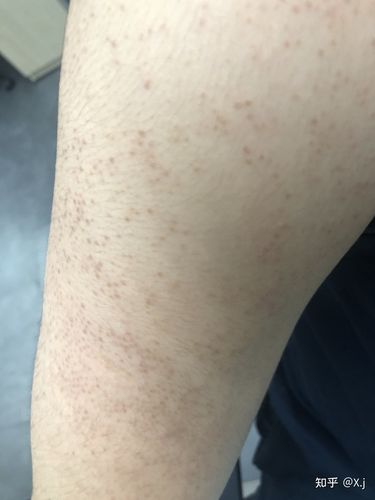 这是不是毛囊炎