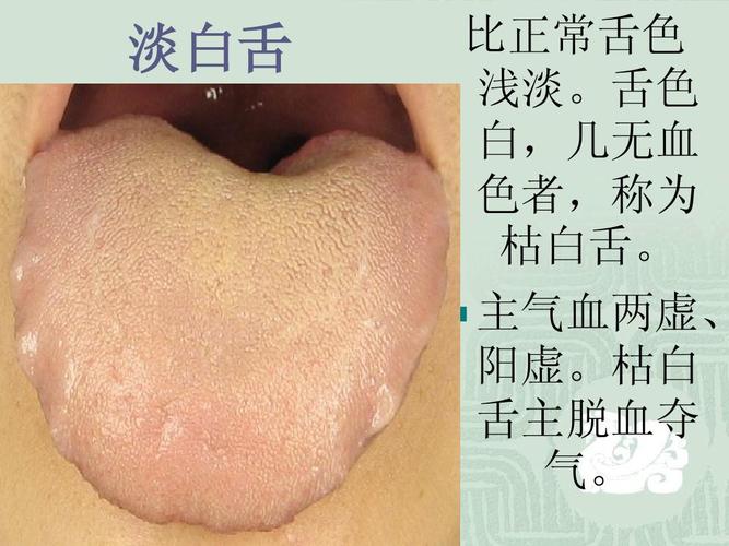 淡白舌 比正常舌色 浅淡.舌色 白,几无血 色者,称为 枯白舌.