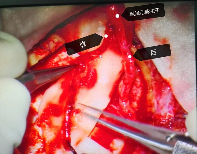 赞皇县医院外三科完成首例颞浅动脉——大脑中动脉搭桥术