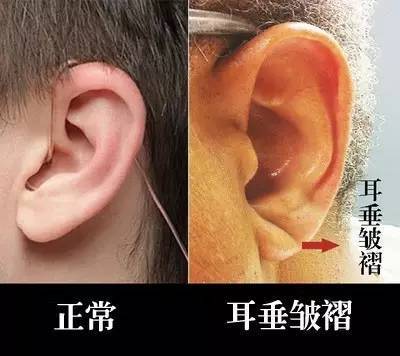 2.耳垂皱褶