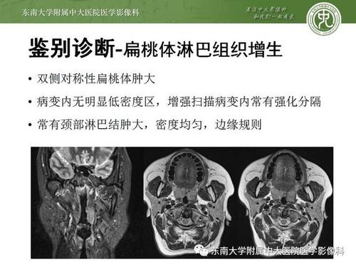 头颈部 | 扁桃体癌影像学表现