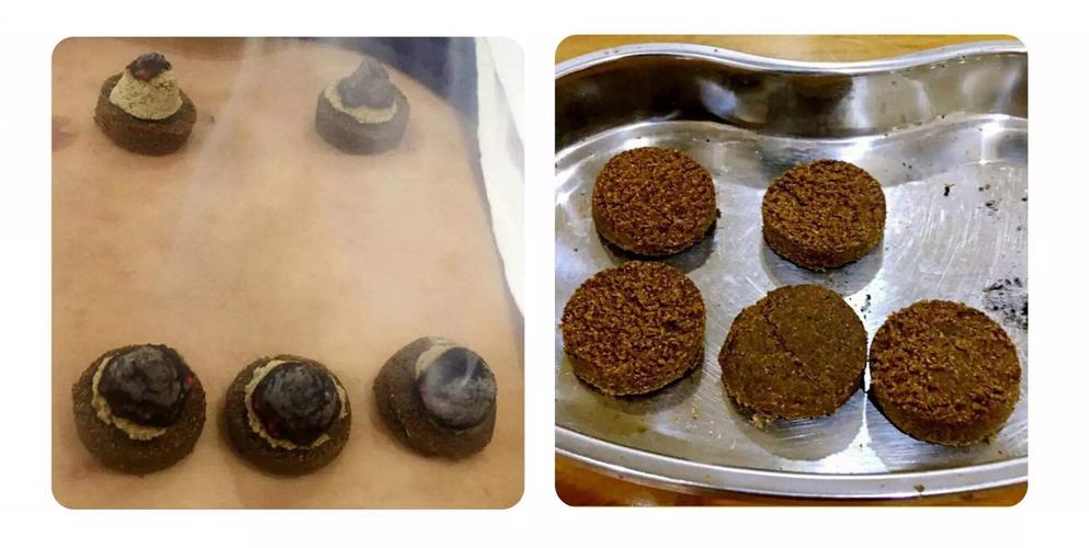 灸除顽固性疾病——澄江县中医院治未病科开展隔药饼灸