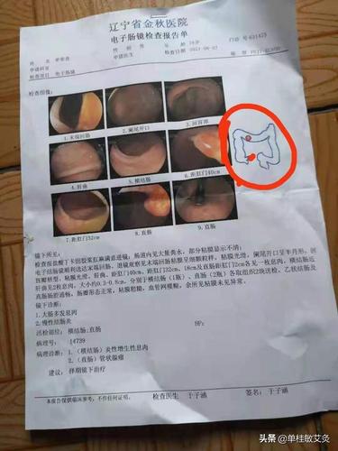 网易首页>网易号>正文申请入驻> 25号上午我开始给他做肛门息肉的火针