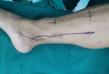 根据自己多年的诊治经验判断,考虑患者胫骨远端肿块可能是骨恶性肿瘤