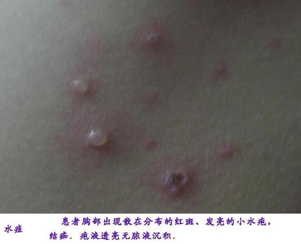 湿疹,痱子,荨麻疹,水痘,痤疮,过敏……婴儿疾病的区别