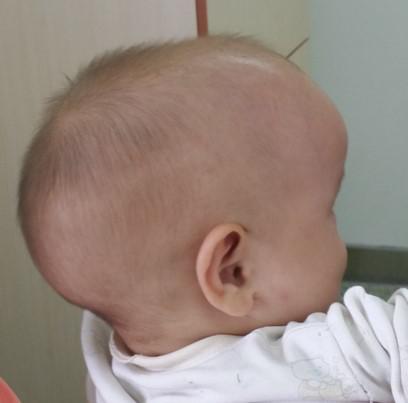 一旦确诊为颅缝早闭,宝妈们一定急迫的想尽早手术,解除对脑