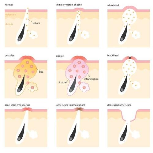 你的"黑头"是假的!