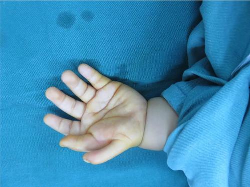 小孩多指切除案例_多指畸形_治疗方法_手术 - 好大夫