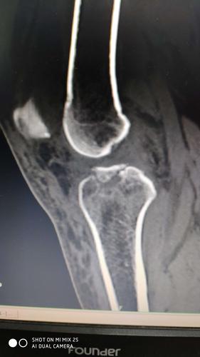 胫骨髁间棘的关节镜治疗病例分享