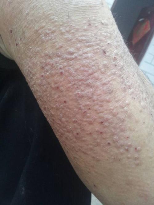 别人说是蛤蟆癣,有什么办法医治么?痒疼