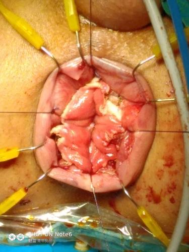 直肠脱垂粘膜加直肠息肉经肛门切除术