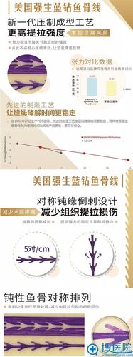 赣州华美整形引进美国强生鱼骨线牛先翠鱼骨线雕真人案例出炉