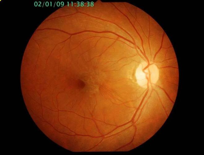 眼底一张照,眼病早知道!关注眼部健康,你要知道这些!