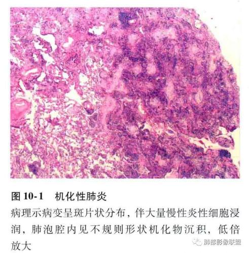 特发性间质性肺炎病理,影像及临床解析——丁啸