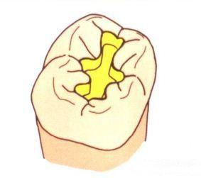 2,如果在牙合面进行了一类洞的制备,牙齿的抗折裂强度会下降8%&m