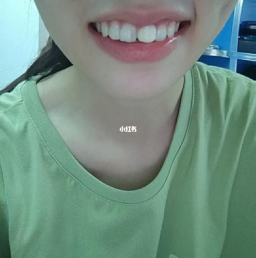 昨天终于去做了全瓷牙_根管治疗_全瓷牙_美妆_医美整形