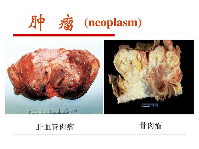 病理学课件 肿 瘤 (neoplasm) 肝血管肉瘤 骨肉瘤