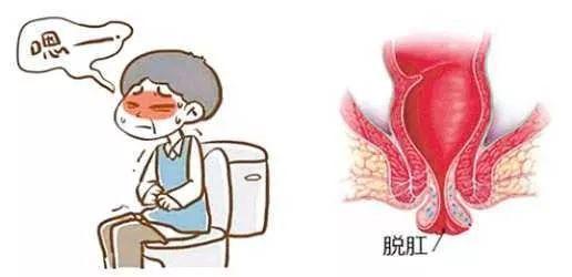 脱肛脱出的小尾巴是直肠还是痔疮