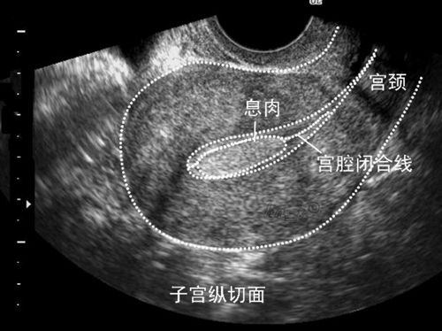 这种疾病一般在育龄到绝经期前的女性身上较为常见,一旦子宫内膜息肉