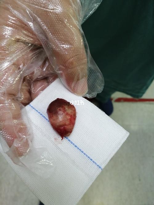 记录一下我做皮脂腺囊肿手术(有图慎入)