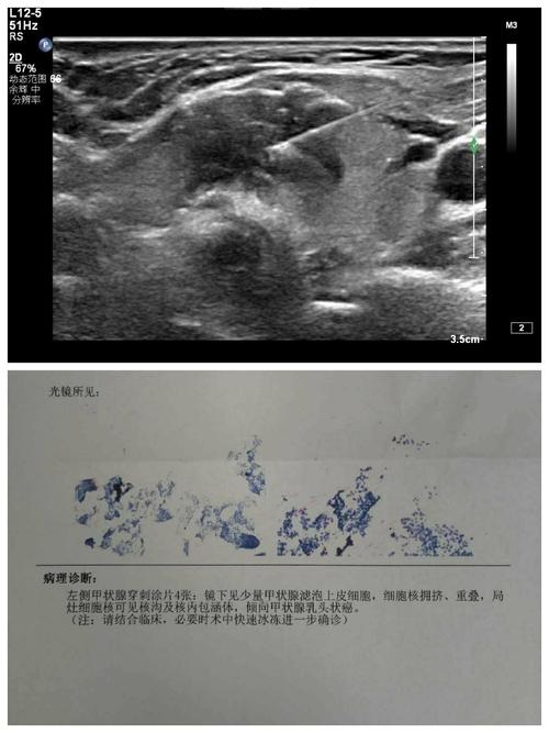 聊一聊甲状腺穿刺活检