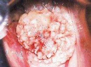 溃疡外观呈菜花样是怎么回事啊?