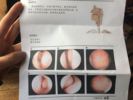 变应性鼻炎,双侧下鼻甲肥大,鼻中隔偏曲.求助!