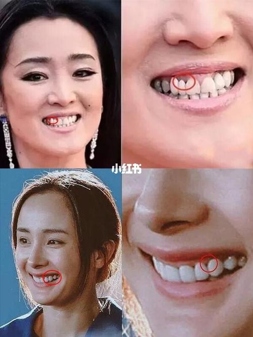 如何识别明星的牙是瓷贴面还是烤瓷牙_牙齿美白_李冰冰_磨牙_杨幂_瓷