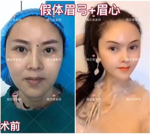 假体垫眉弓.会有后遗症么?