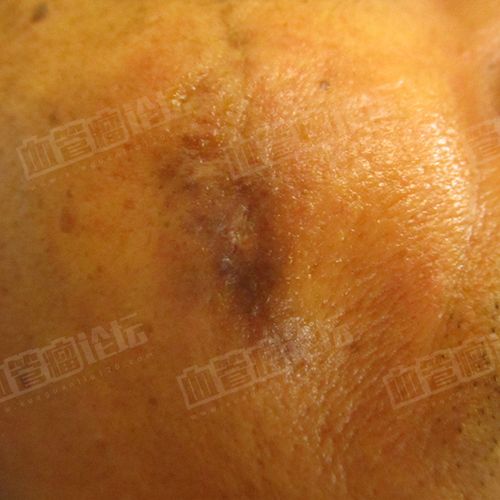 来自杨权成人面部静脉畸形海绵状血管瘤患者日记