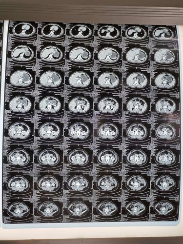 甘肃省人民医院普外二科(肝胆胰外科)成功实施超声精准定位下的腹腔镜