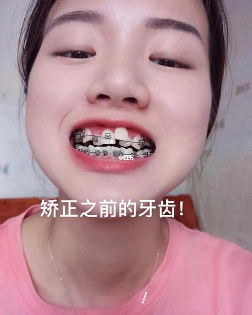 牙套_美女_变美_美妆_医美整形