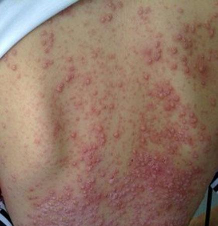 得了艾滋病可以不治疗吗_寻医问药网皮肤性病科频道