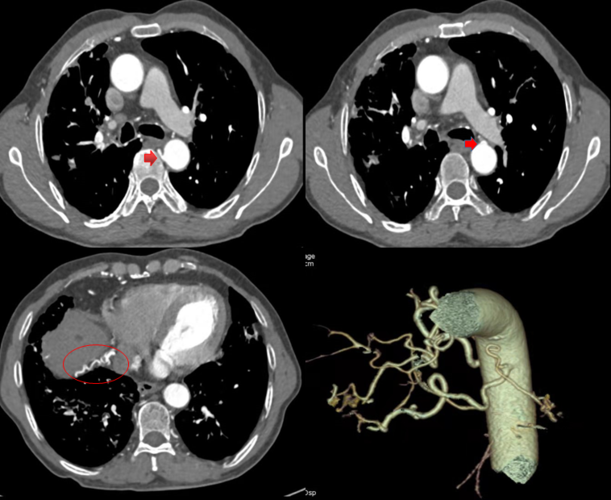 8spheres用于支气管动脉栓塞术治疗支气管扩张伴咯血一例