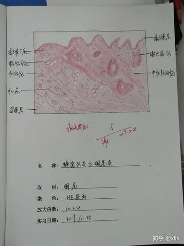 蜂窝织炎性阑尾炎 红蓝铅笔手绘