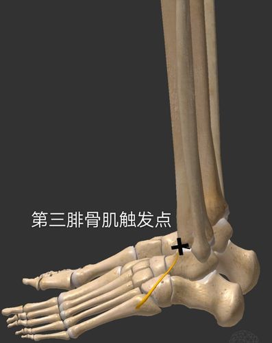 小腿,踝,足部③其他4/4莫顿足(二脚趾长于大脚趾)