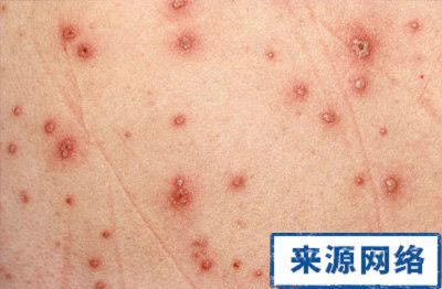 水痘常见症状图片(2)