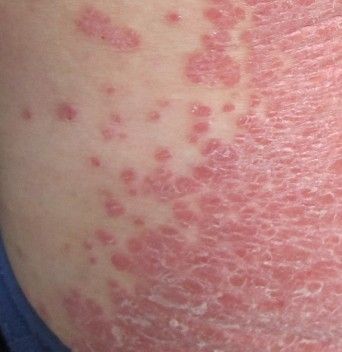 汗癣是什么样子的图