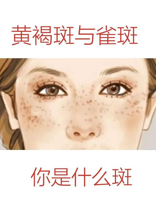 那下面就我们来看一下黄褐斑和雀斑两者之间有什么区别吧.