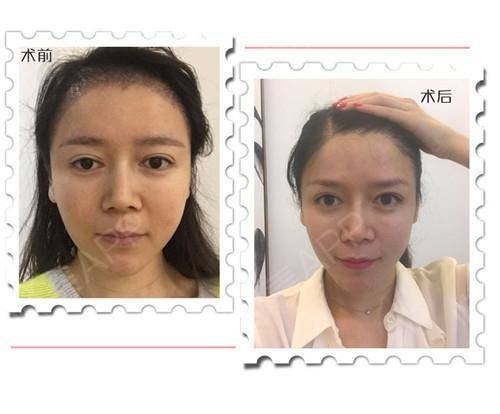 【免费招募北京站】面部吸脂,鼻综合,丰眉弓 各2名