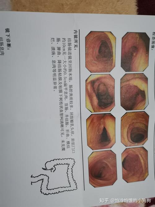 肠镜检出肠息肉,会是恶性的吗