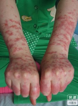 白塞病跟红斑狼疮有何区别