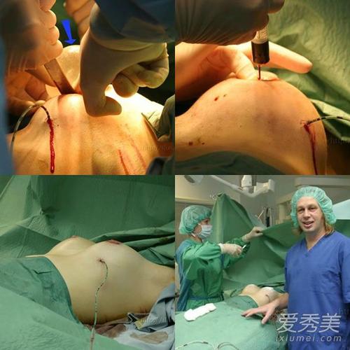 直击隆胸手术现场!胆小的就别点进来了