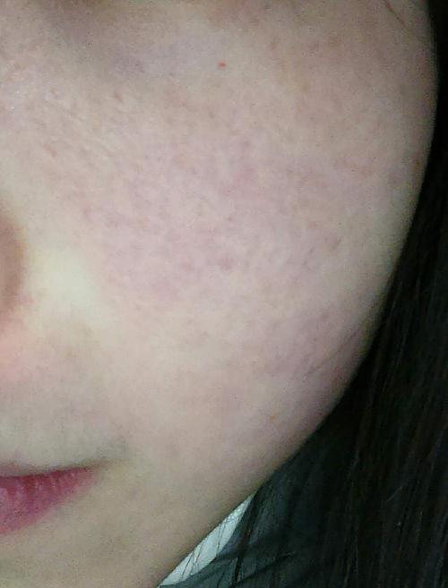 过敏了.哪些修复精华可以用?求助!