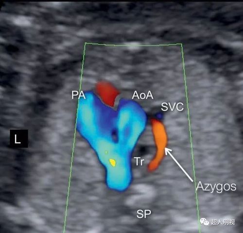 充分理解胎儿三血管气管切面(正常篇)