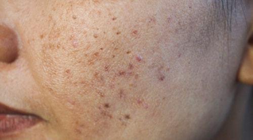 红色痘印(炎症后的红斑)和黑褐色痘印(炎症过后的色素沉着过度)