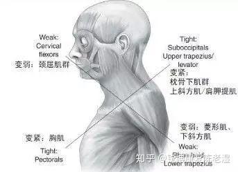 当后上背部和颈部肌肉肌力弱且肌肉被动拉长,而前侧肌肉又很紧张就会