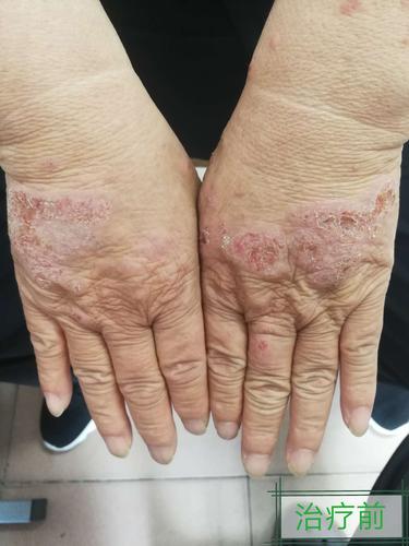 病例讨论:面颈,双上肢起红斑丘疹伴痒,诊断应是?