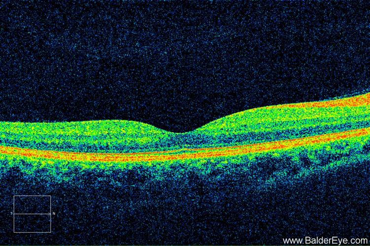 正常黄斑oct图